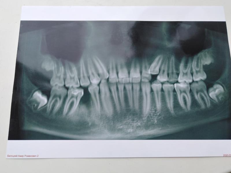 Нужно ли удалять корни. Корни зуба мудрости на рентгене. Рентген зубов зуб мудрости.