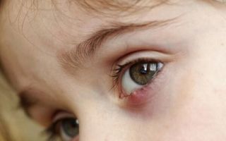 Все о ячмене на глазу у ребенка: первые симптомы и лечение
