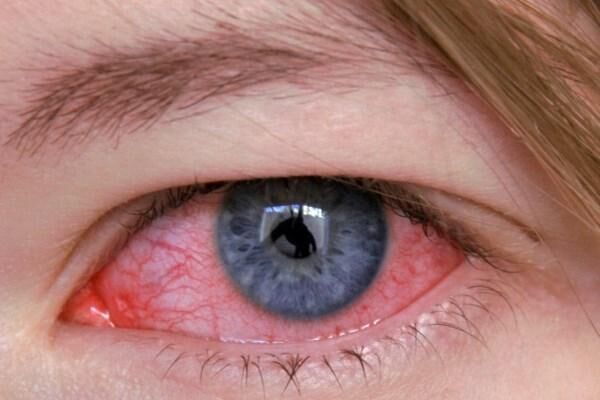 Воспалительный процесс органа зрения
