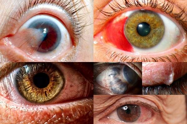 Неинфекционные заболевания глаз