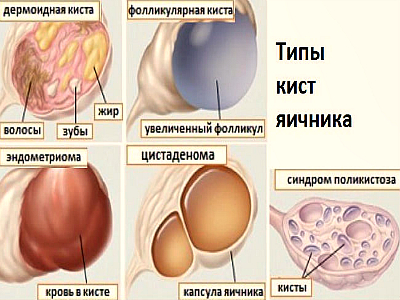 Виды кист