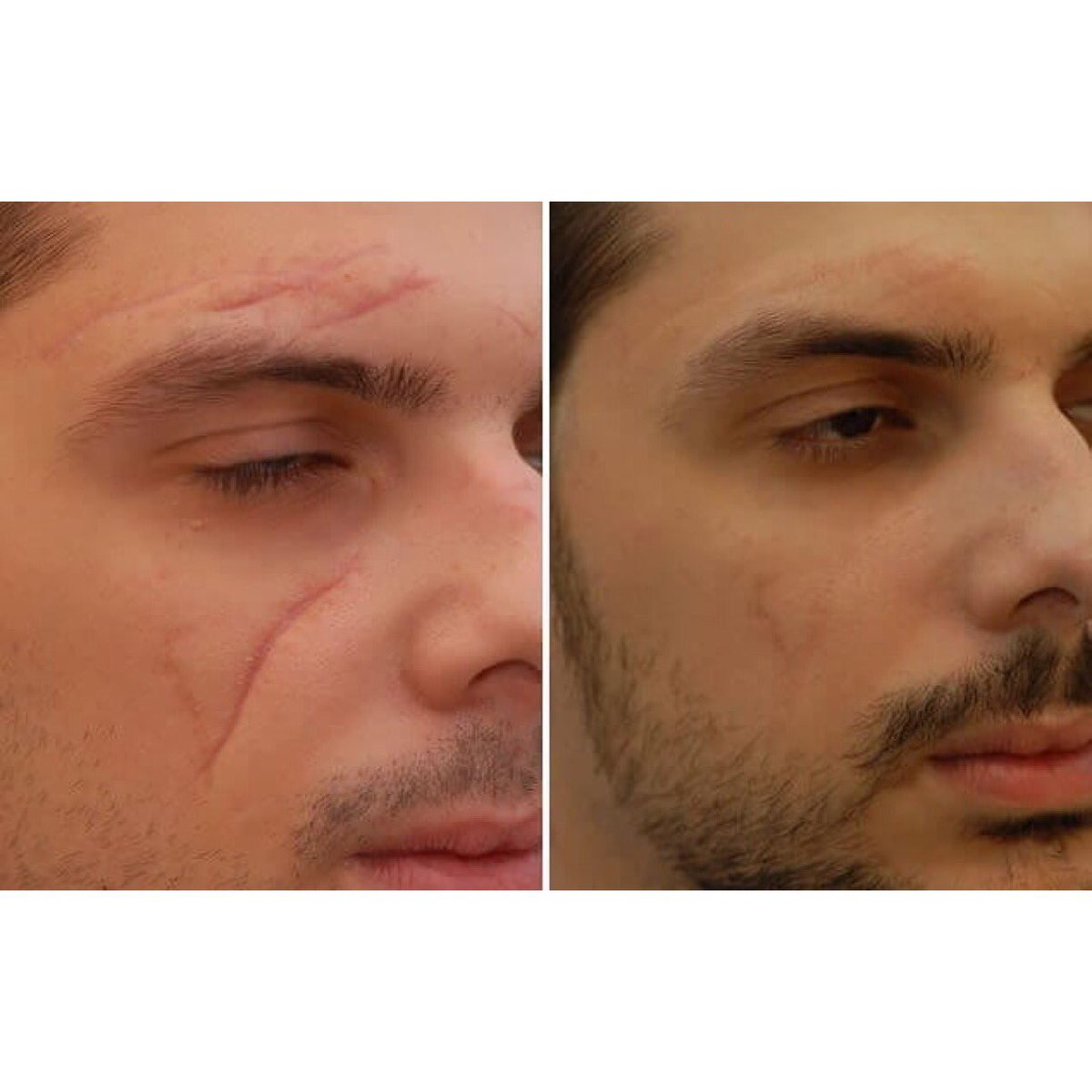Шрам на лице после операции