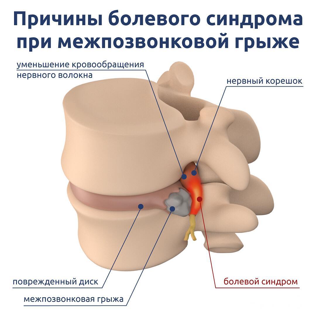 Позвоночная грыжа симптомы картинки