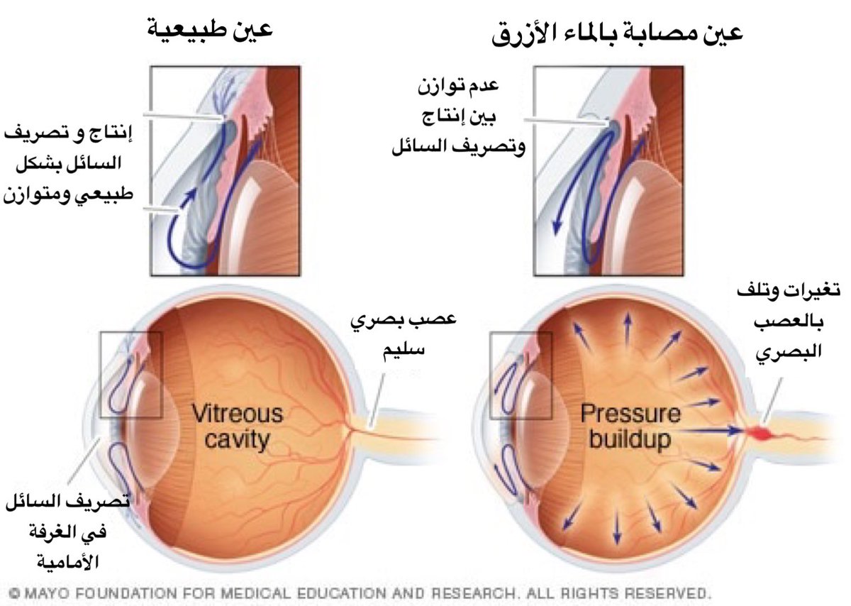 Глаукома латынь. Анатомия глаза глаукома. Глаукома строение глаза. Терминальная глаукома.