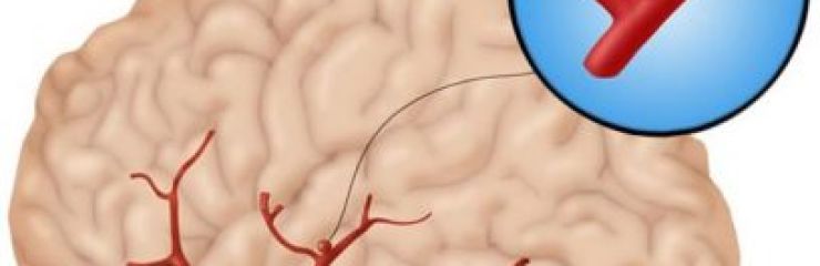Аневризма головного мозга симптомы и лечение