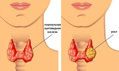 Увеличение щитовидной железы часто связано с развитием зоба и воспалительных процессов
