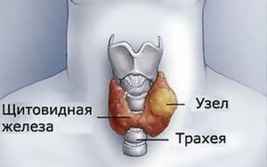 Тиреоидит щитовидной железы с узлообразованием