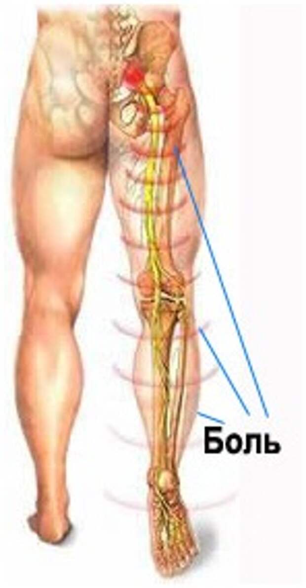 Ноет спина ноги. Седалищный нерв и грыжа l5 s1. Защемление седалищного нерва s1.