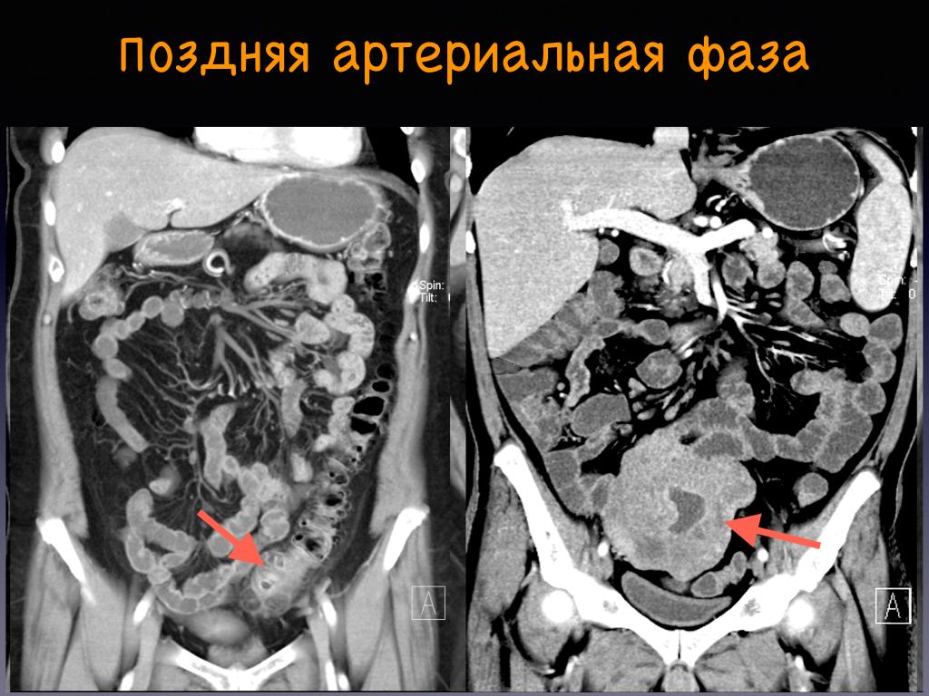 Что показывает кт брюшной. Кт брюшной полости (контрастирование. Кт почек с болюсным контрастированием. Контрастирование при кт брюшной полости. Болюсное контрастирование при кт брюшной полости.