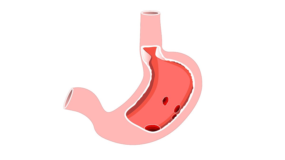 Язва желудка картинки для детей