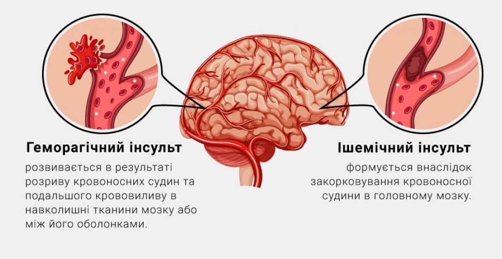 Ишемический и геморрагический инсульт. Ишемический инсульт и геморрагический инсульт. Геморрагический инсульт причины.