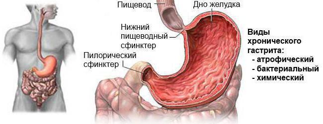 катаральный гастрит