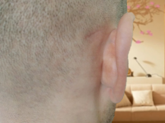 Пример лимфатического бугорка за ухом