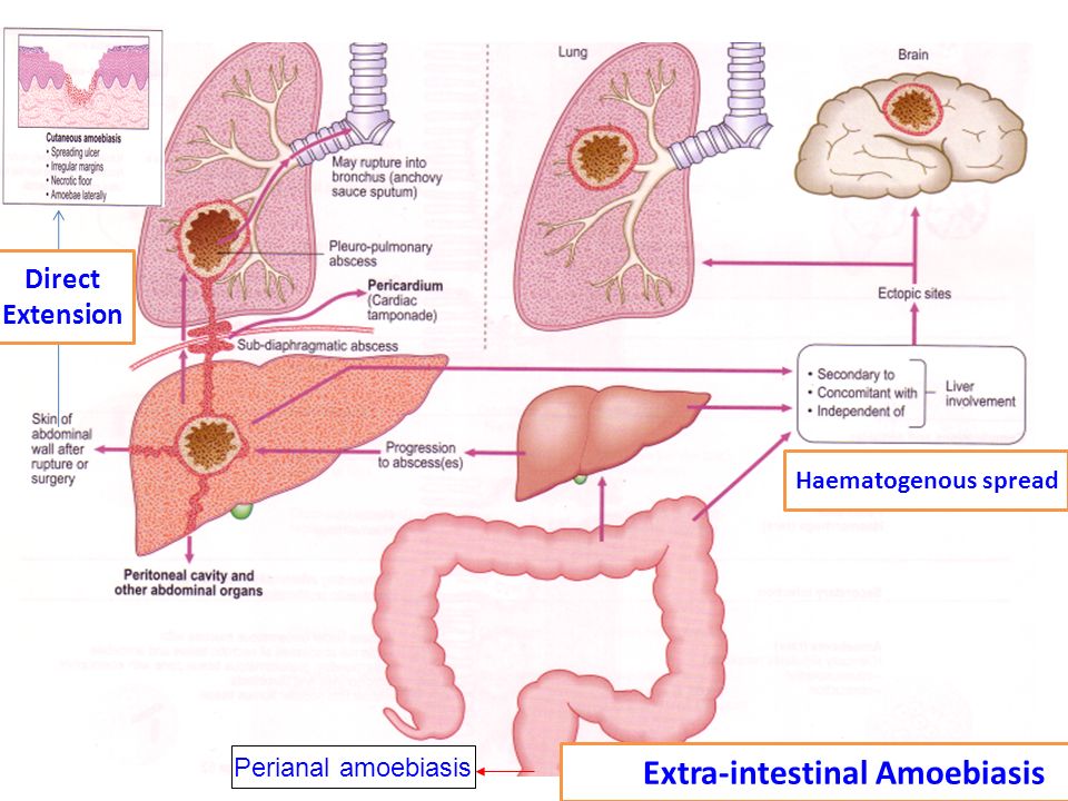Амебиаз. Внекишечные формы амебиаза. Внекишечный амебиаз схема.