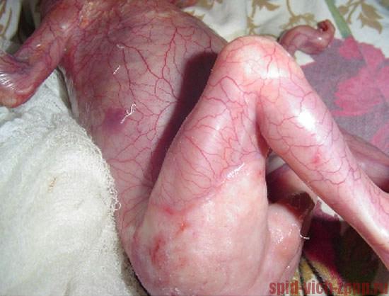 Фото. Последствия герпеса у материя для новорожденного.