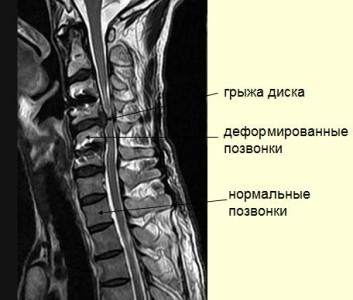 Остеохондроз на снимке МРТ