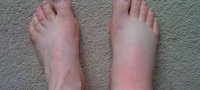 Каковы причины отека левой ноги в области ступни?