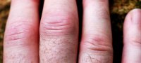Почему опухают пальцы, кисти и руки — причины и методы лечения
