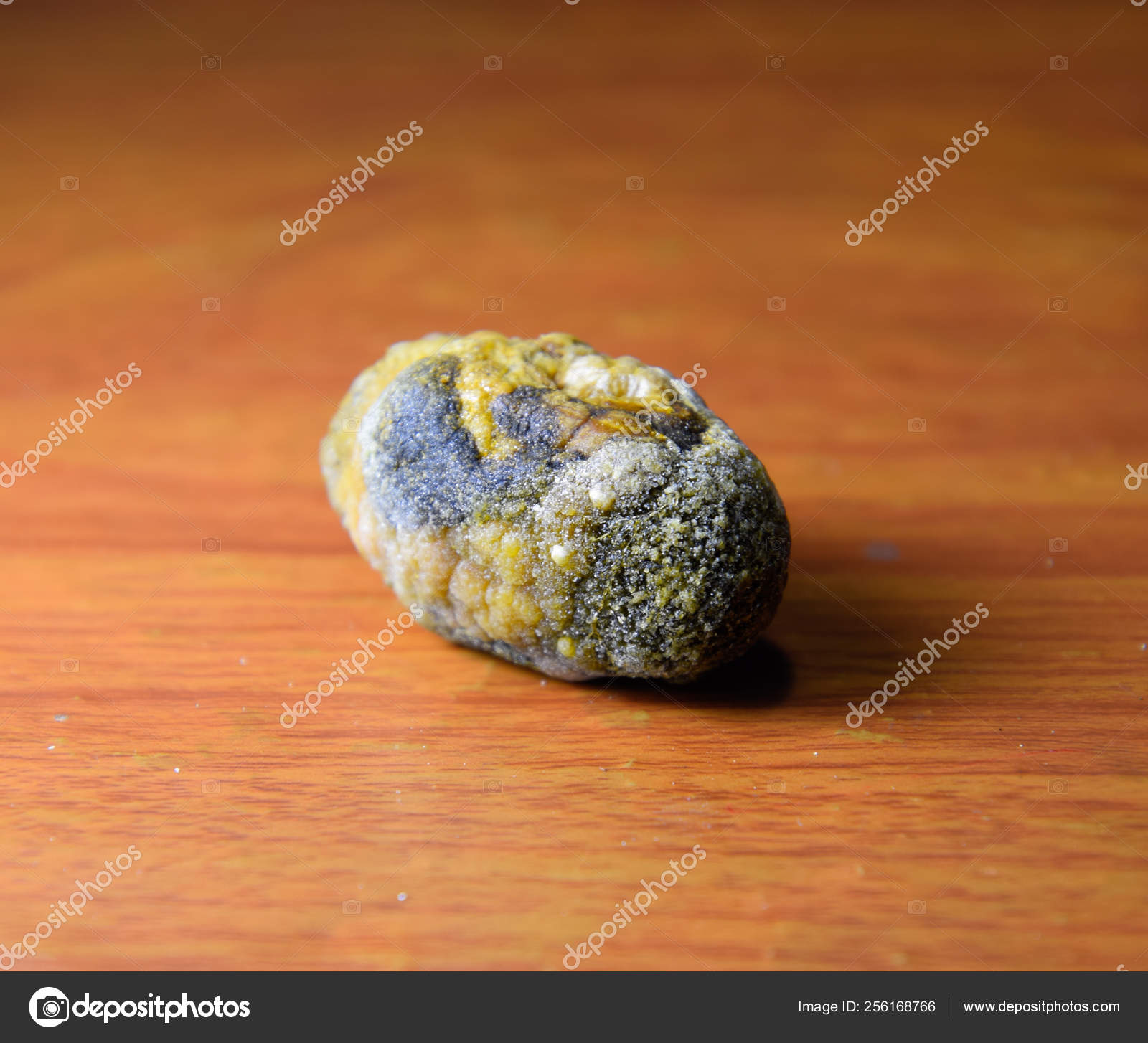 Пигментные камни в желчном пузыре