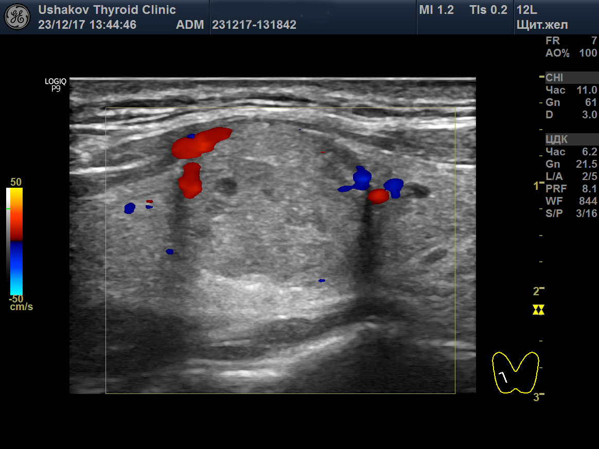 Диффузный токсический зоб узи картина