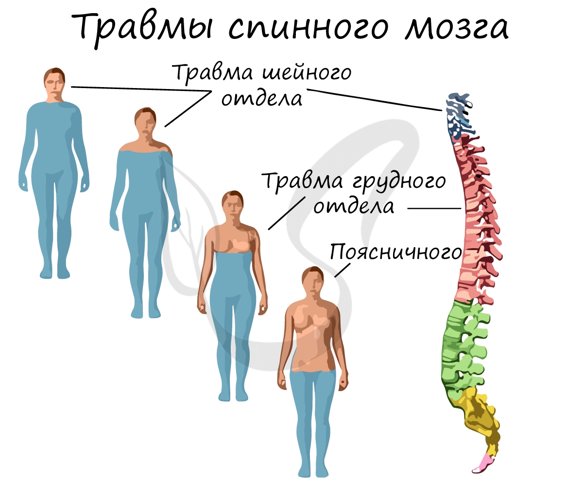 Травмы спинного мозга