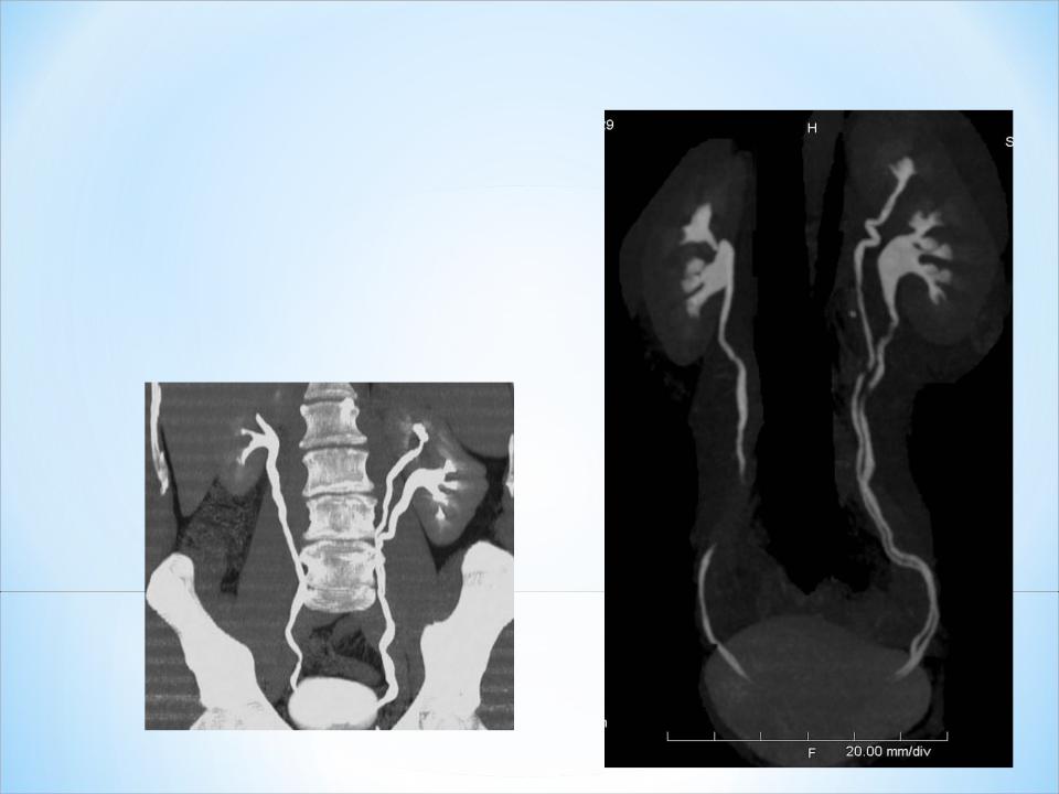 Удвоенная почка у взрослого фото