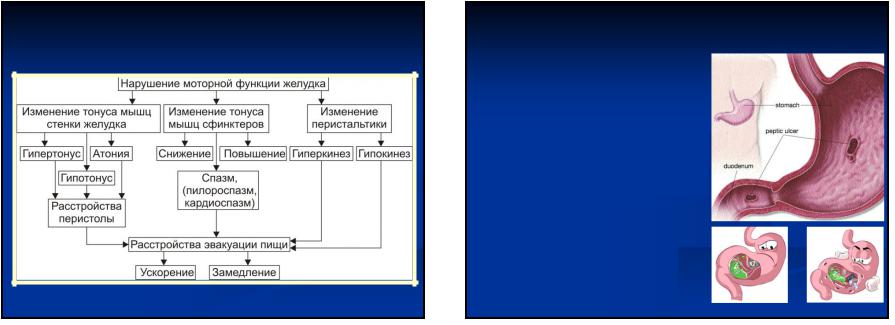 Атония жкт. Механизмы симптомов нарушения моторной функции желудка. Нарушения моторной функции ЖКТ. Нарушение двигательной функции желудка. Повышение тонуса желудка.