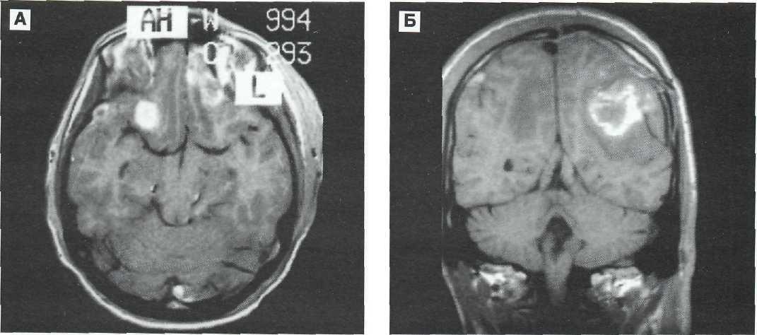 Мр картина супратенториальных очагов глиоза