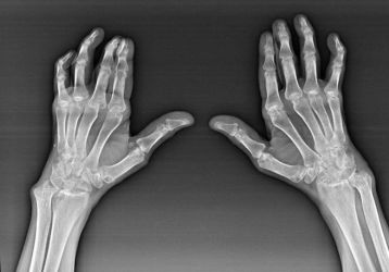 Артроз кисти рук и его лечение, причины и симптомы заболевания