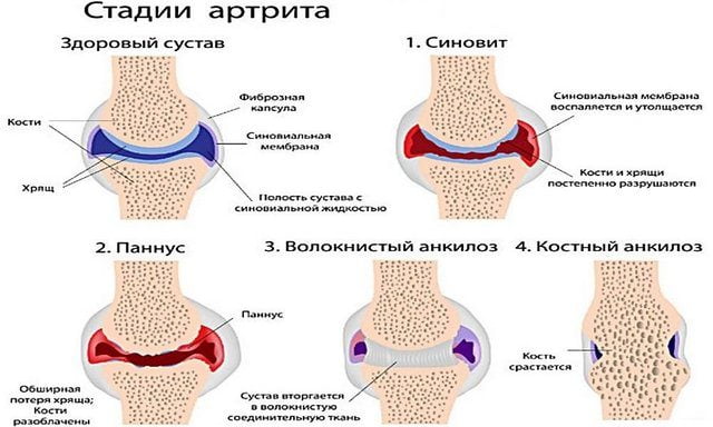 Пораженный артритом сустав