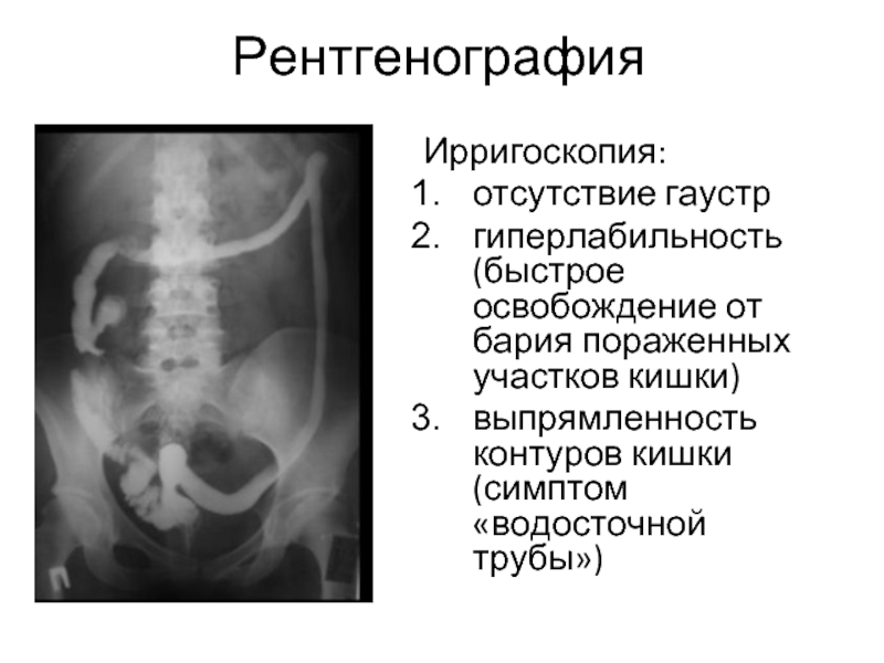 Ирригоскопия подготовка. Неспецифический язвенный колит рентген. Ирригоскопия показания.