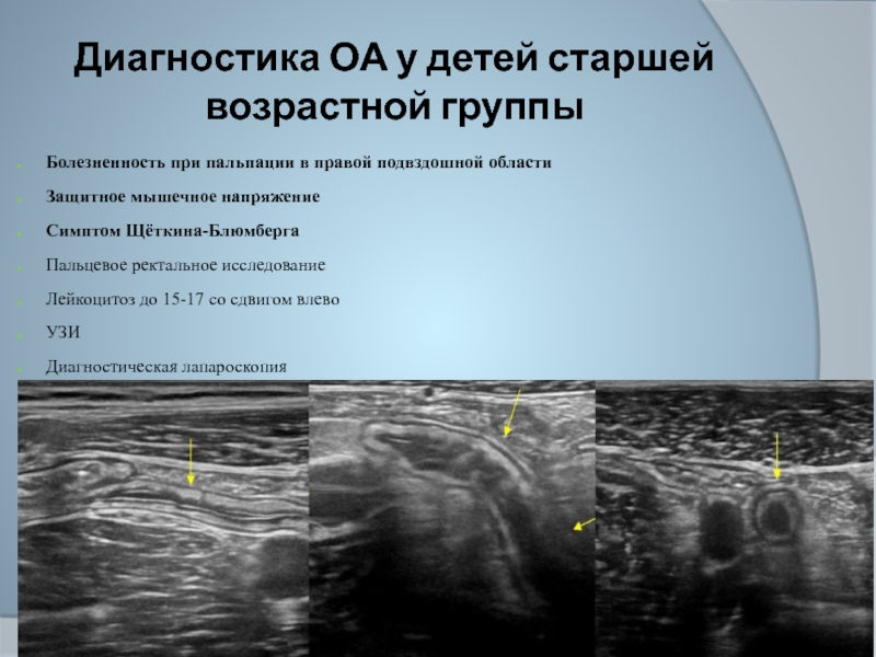 Аппендицит у детей год. Пальцевое исследование при остром аппендиците. Острый аппендицит у детей УЗИ. Пальпация при аппендиците у детей.