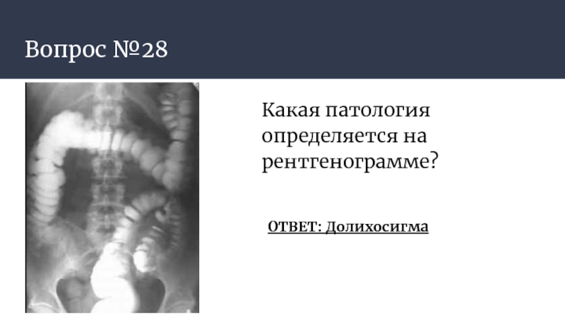 Долихосигма что это такое. Долихосигма ирригоскопия. Ирригоскопия кишечника долихосигма.