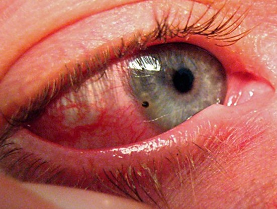 Поврежденные глаза после сварки