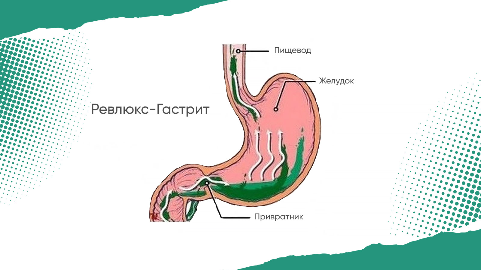 Лечение забросов в пищевод. Гастрит рефлюкс эзофагит. Дуоденальный гастрит рефлюкс. Что такое дуодено-гастральный рефлюкс желудка. Рефлюкс-эзофагит симптомы язык.