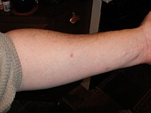 Mantoux tuberculin skin test.jpg
