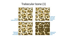 Spongy bone - Trabecular bone - Normal trabecular bone Trabecular bone etc -- Smart-Servier.jpg
