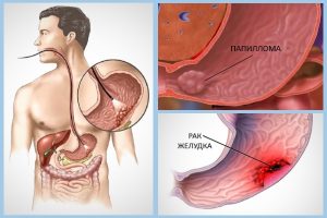 Папиллома и рак желудка