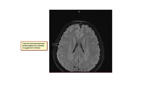 Мр картина множественных супратенториальных очагов глиоза сосудистого генеза