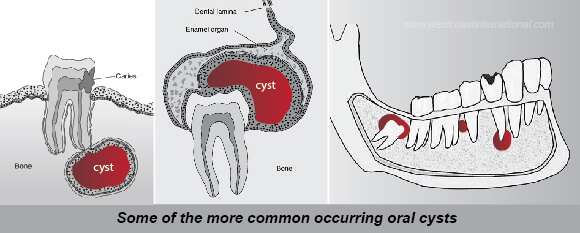 Dental Cysts Vietnam