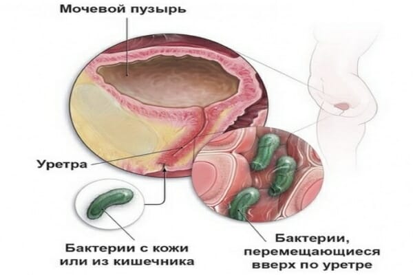 Бактерии в уретре