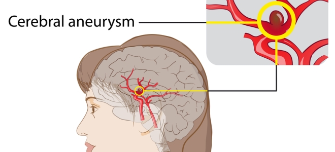 признаки аневризмы сосудов головного мозга