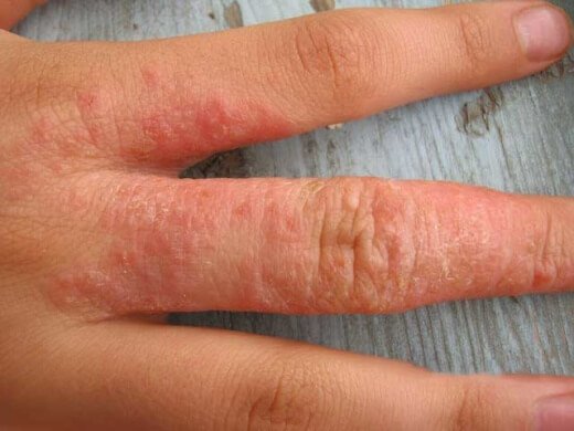 аллергия на бытовую химию кожа рук крупно