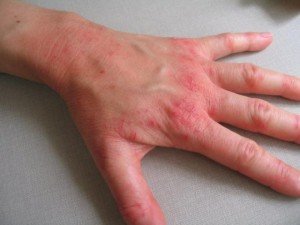 аллергия на бытовую химию кожа рук