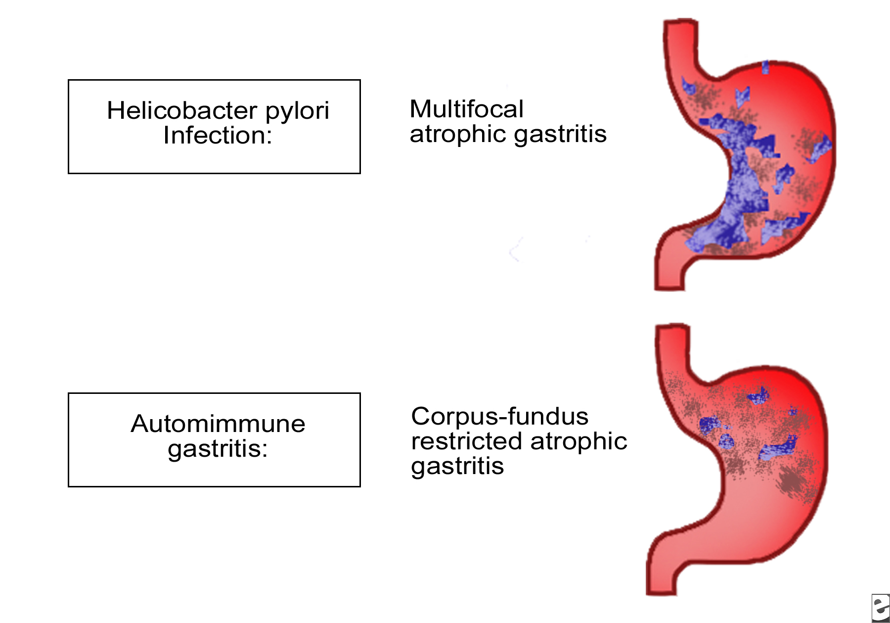 Gastritis atrofica dieta