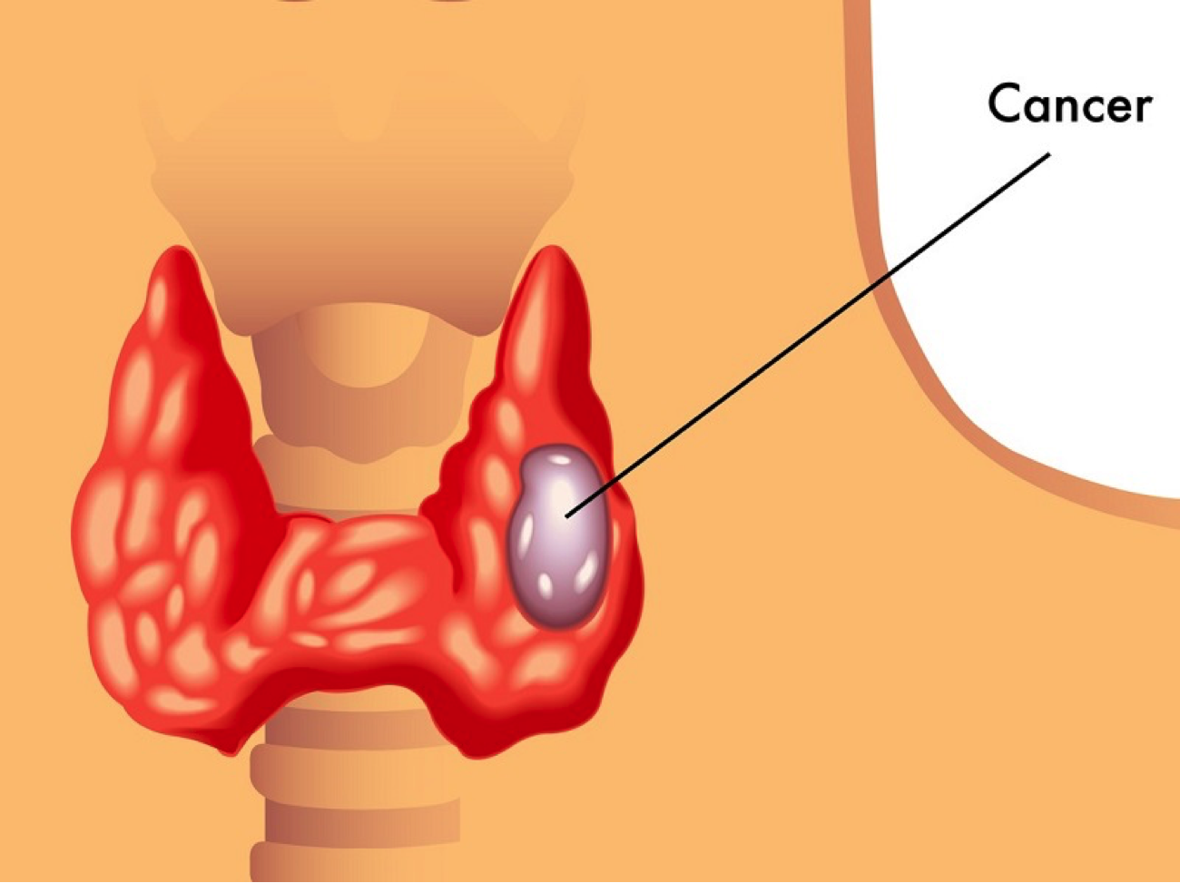 Увеличился узел щитовидной железы. Узловые кисты щитовидной железы. Щитовидная железа зоб узлы. Киста щитовидной железы и лимфоузлах.