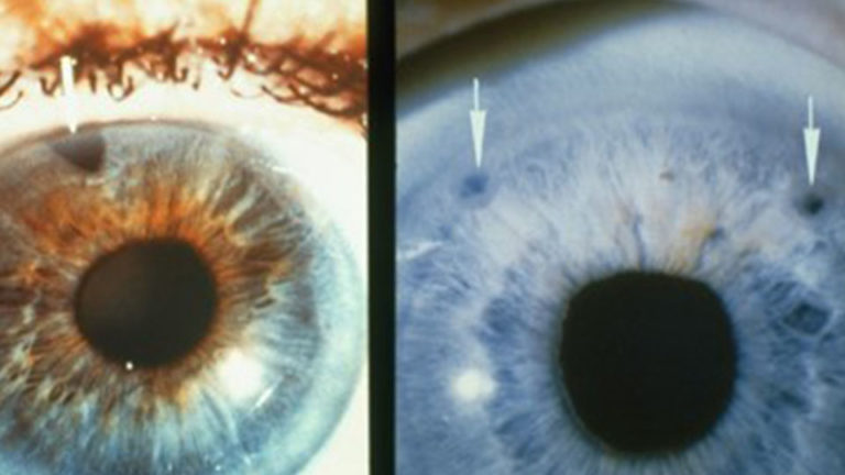 Для открытоугольной глаукомы характерны тест. Неоваскулярная глаукома. Закрытоугольная глаукома. Закрытоугольная глаукома глаза. Глаукома ювенильная открытоугольная.