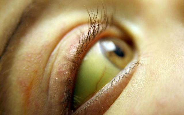 14 признаков плохого здоровья, определяемые по глазам