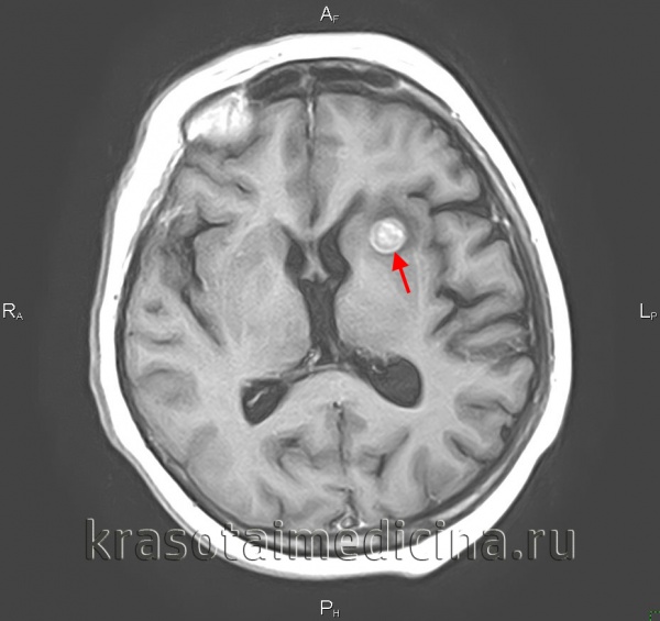 МРТ головного мозга. Вторичная опухоль в области базальных ядер слева, накапливающая контраст