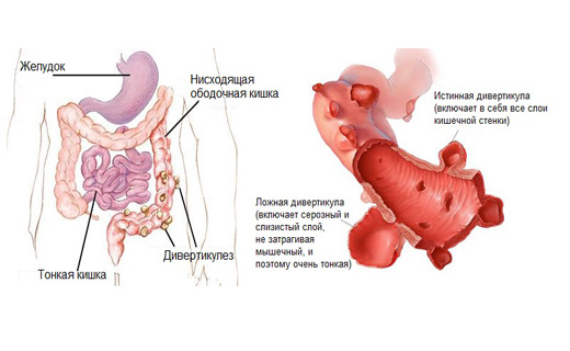 средства от дивертикулеза
